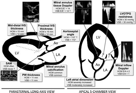 normal interventricular septum thickness